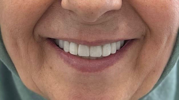 Zirkonyum kaplama öncesi ve sonrası - Önce